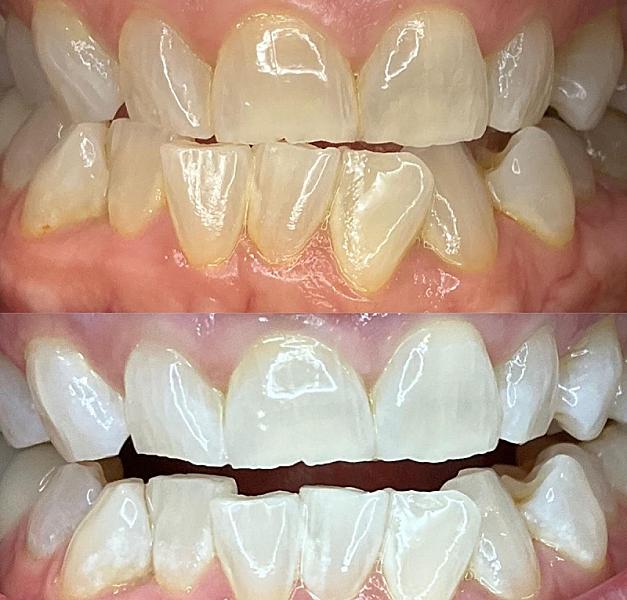 We Whiten Teeth Whitening
