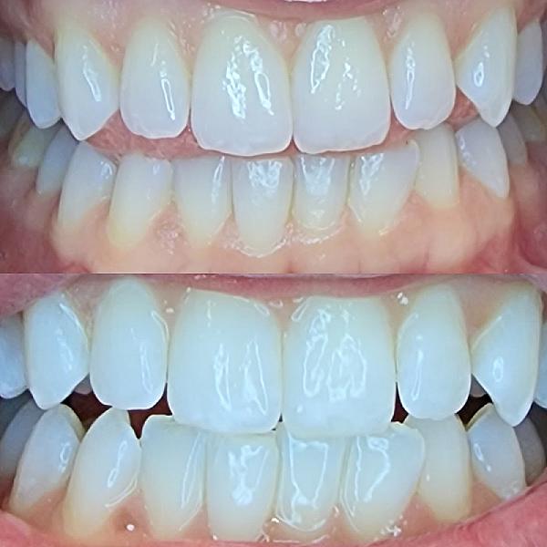 We Whiten Teeth Whitening